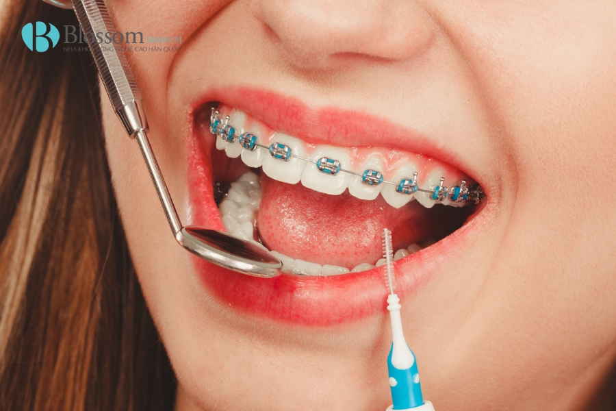 Niềng răng có được vĩnh viễn không? Giải đáp từ chuyên gia nha khoa 6 nieng rang co duoc vinh vien khong 6