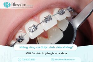 Niềng răng có được vĩnh viễn không? Giải đáp từ chuyên gia nha khoa