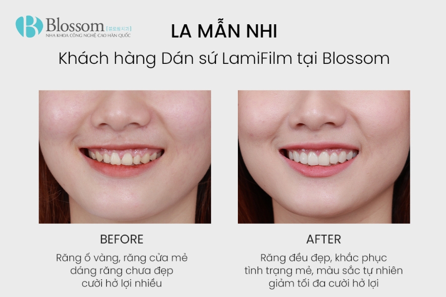 Phân biệt dán sứ Lamifilm và Veneer: Đâu là lựa chọn phù hợp cho nụ cười của bạn? 4 phan biet dan su lamifilm va veneer 3