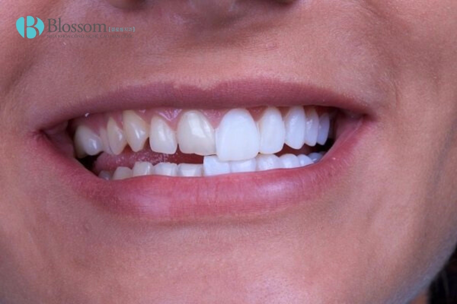 Phân biệt dán sứ Lamifilm và Veneer: Đâu là lựa chọn phù hợp cho nụ cười của bạn? 5 phan biet dan su lamifilm va veneer 4