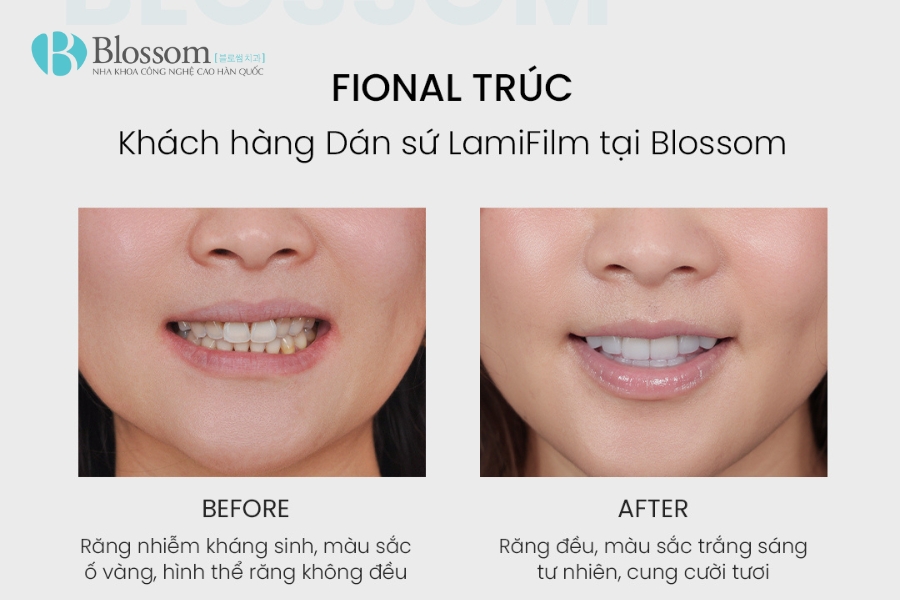 Phân biệt dán sứ Lamifilm và Veneer: Đâu là lựa chọn phù hợp cho nụ cười của bạn? 6 phan biet dan su lamifilm va veneer 5