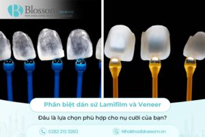 Phân biệt dán sứ Lamifilm và Veneer: Đâu là lựa chọn phù hợp cho nụ cười của bạn?