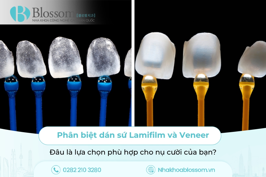 Phân biệt dán sứ Lamifilm và Veneer: Đâu là lựa chọn phù hợp cho nụ cười của bạn?