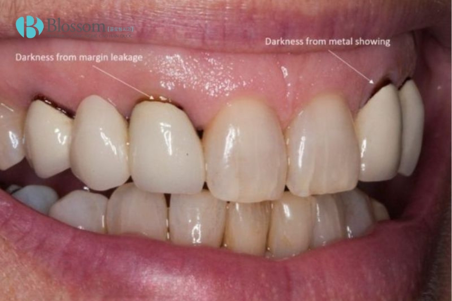 Răng sứ bị ngấm nước bọt: Tại sao 99% phải thay răng mới? Cách khắc phục từ chuyên gia 1 rang su bi ngam nuoc bot 1 1