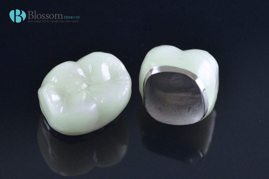 Răng sứ bị ngấm nước bọt: Tại sao 99% phải thay răng mới? Cách khắc phục từ chuyên gia 2 rang su bi ngam nuoc bot 2 1