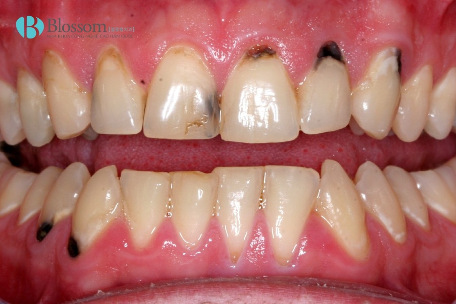 Răng sứ bị ngấm nước bọt: Tại sao 99% phải thay răng mới? Cách khắc phục từ chuyên gia 3 rang su bi ngam nuoc bot 3 1
