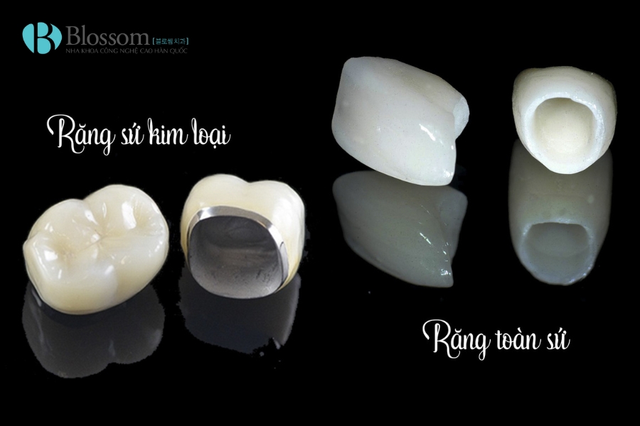 Răng sứ bị ngấm nước bọt: Tại sao 99% phải thay răng mới? Cách khắc phục từ chuyên gia 4 rang su bi ngam nuoc bot 4 1