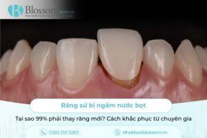 Răng sứ bị ngấm nước bọt: Tại sao 99% phải thay răng mới? Cách khắc phục từ chuyên gia