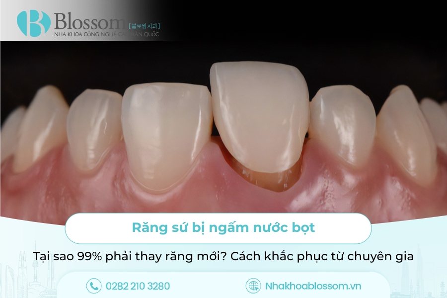 Răng sứ bị ngấm nước bọt: Tại sao 99% phải thay răng mới? Cách khắc phục từ chuyên gia