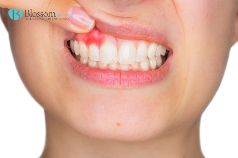 Khi nào cần thay răng sứ bị hư? Những điều bạn nhất định phải biết! 2 thay rang su bi hu 2