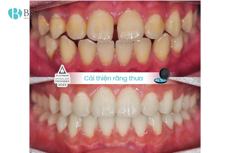Vì sao răng thưa? Nguyên nhân, ảnh hưởng và cách khắc phục hiệu quả 4 vi sao rang thua 4