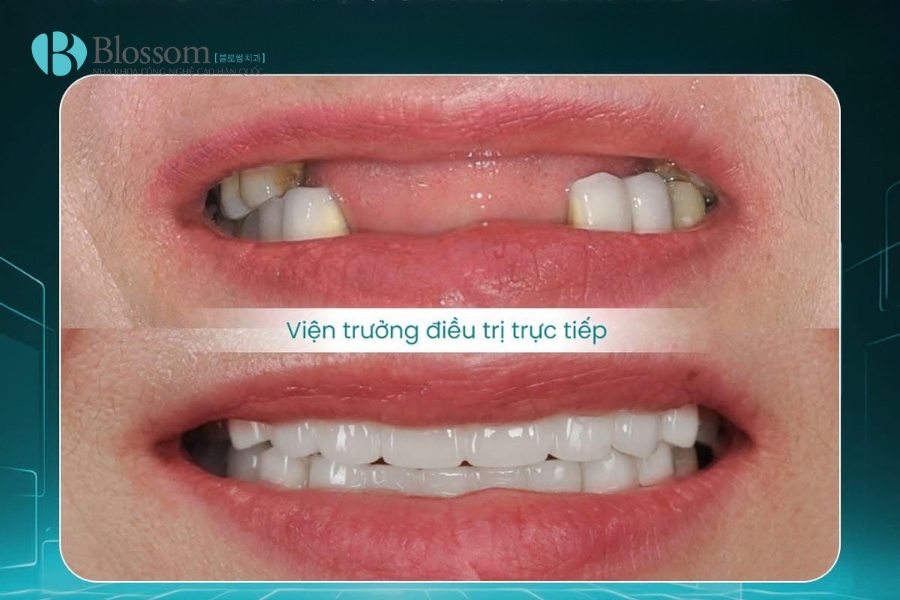Vì sao răng thưa? Nguyên nhân, ảnh hưởng và cách khắc phục hiệu quả 5 vi sao rang thua 5