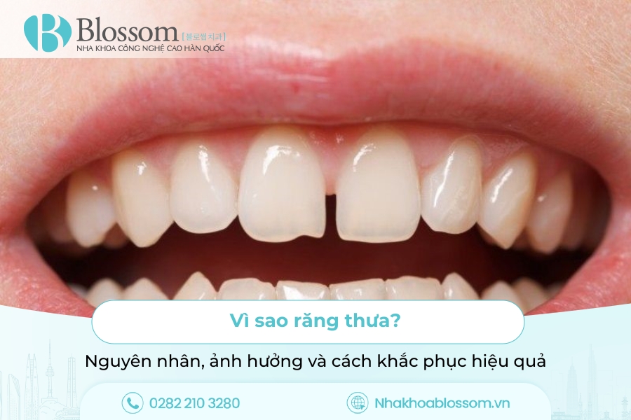 Vì sao răng thưa? Nguyên nhân, ảnh hưởng và cách khắc phục hiệu quả