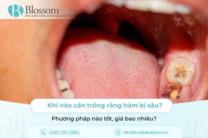 Khi nào cần trồng răng hàm bị sâu? Phương pháp nào tốt, giá bao nhiêu?