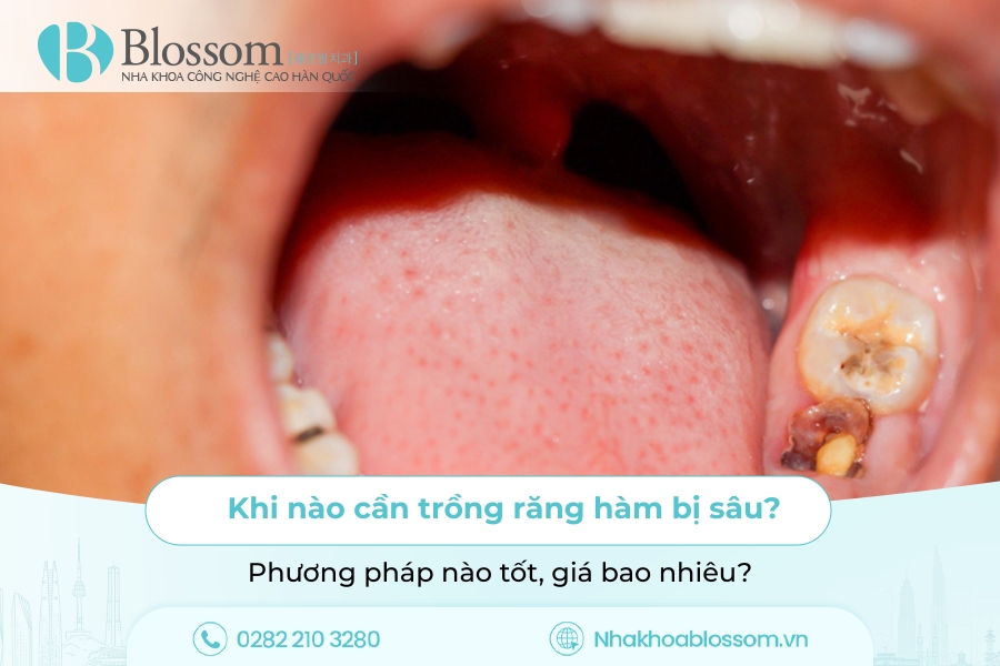 Khi nào cần trồng răng hàm bị sâu? Phương pháp nào tốt, giá bao nhiêu?