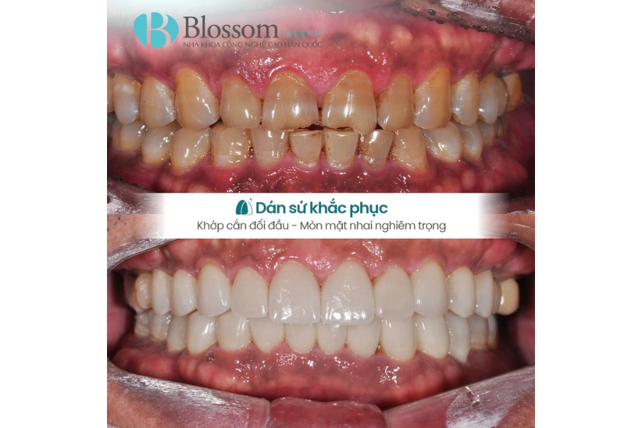 Mòn răng trầm trọng: Nguyên nhân, hậu quả và giải pháp phục hồi hiệu quả với dán sứ Lamifilm 11 mon rang tram trong 10