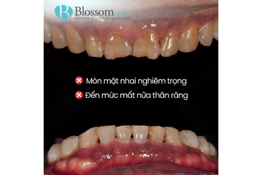Mòn răng trầm trọng: Nguyên nhân, hậu quả và giải pháp phục hồi hiệu quả với dán sứ Lamifilm 10 mon rang tram trong 11