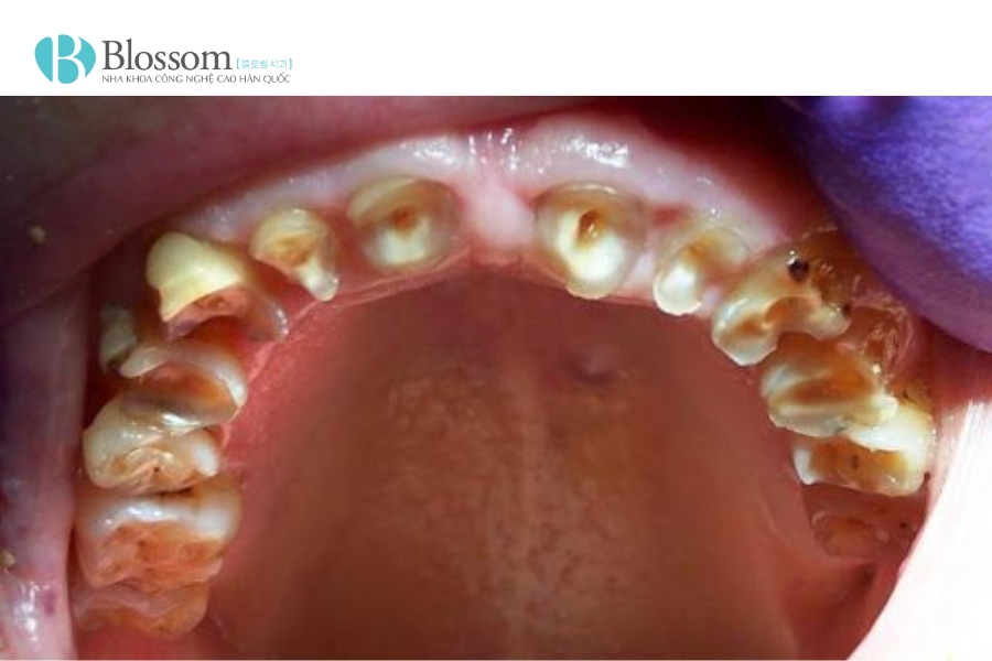 Mòn răng trầm trọng: Nguyên nhân, hậu quả và giải pháp phục hồi hiệu quả với dán sứ Lamifilm 2 mon rang tram trong 2