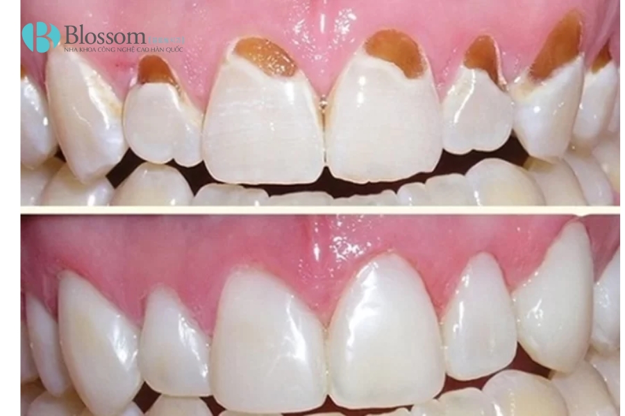 Mòn răng trầm trọng: Nguyên nhân, hậu quả và giải pháp phục hồi hiệu quả với dán sứ Lamifilm 4 mon rang tram trong 4