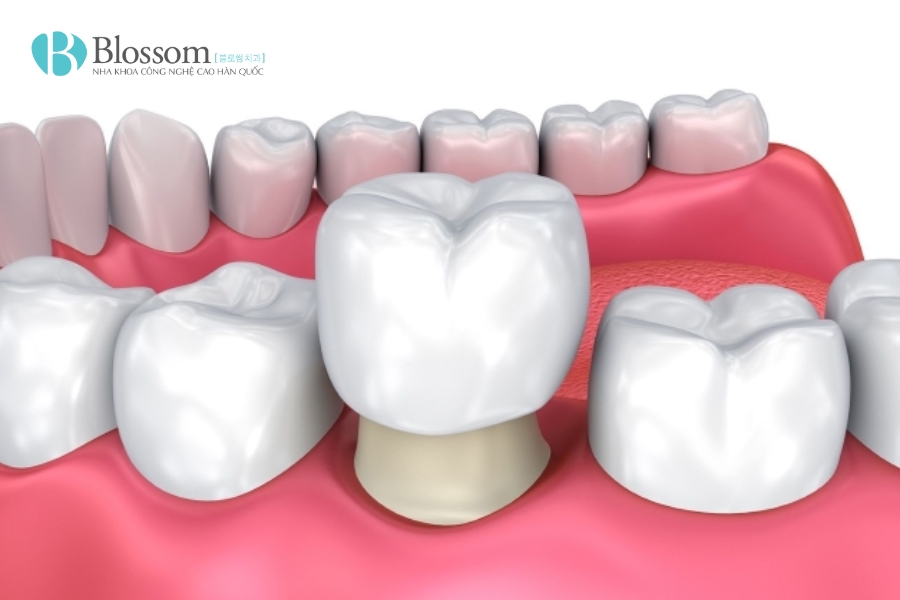 Mòn răng trầm trọng: Nguyên nhân, hậu quả và giải pháp phục hồi hiệu quả với dán sứ Lamifilm 5 mon rang tram trong 5
