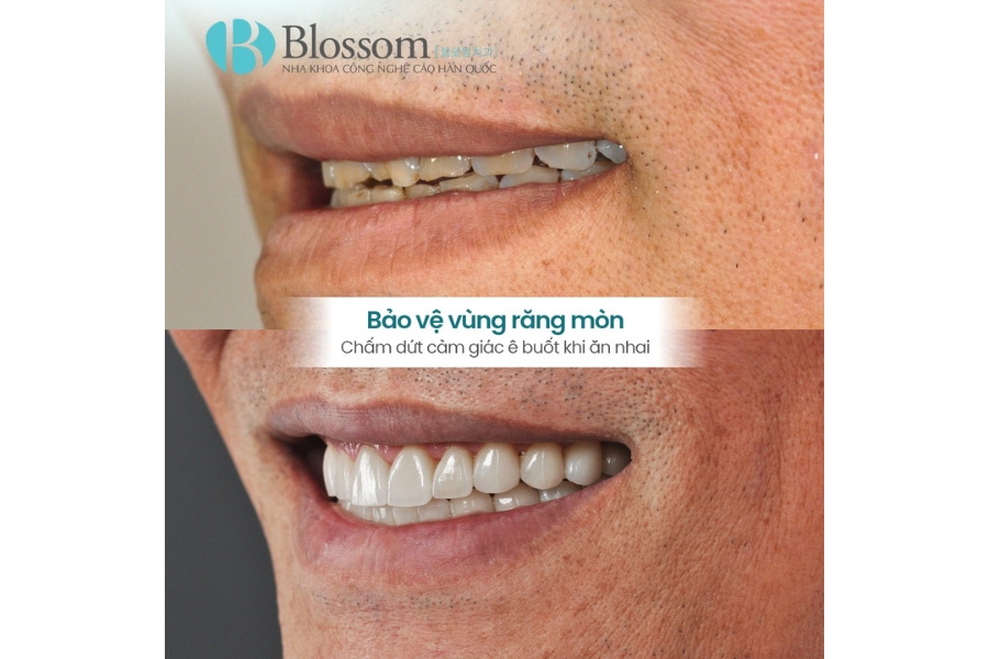 Mòn răng trầm trọng: Nguyên nhân, hậu quả và giải pháp phục hồi hiệu quả với dán sứ Lamifilm 6 mon rang tram trong 6