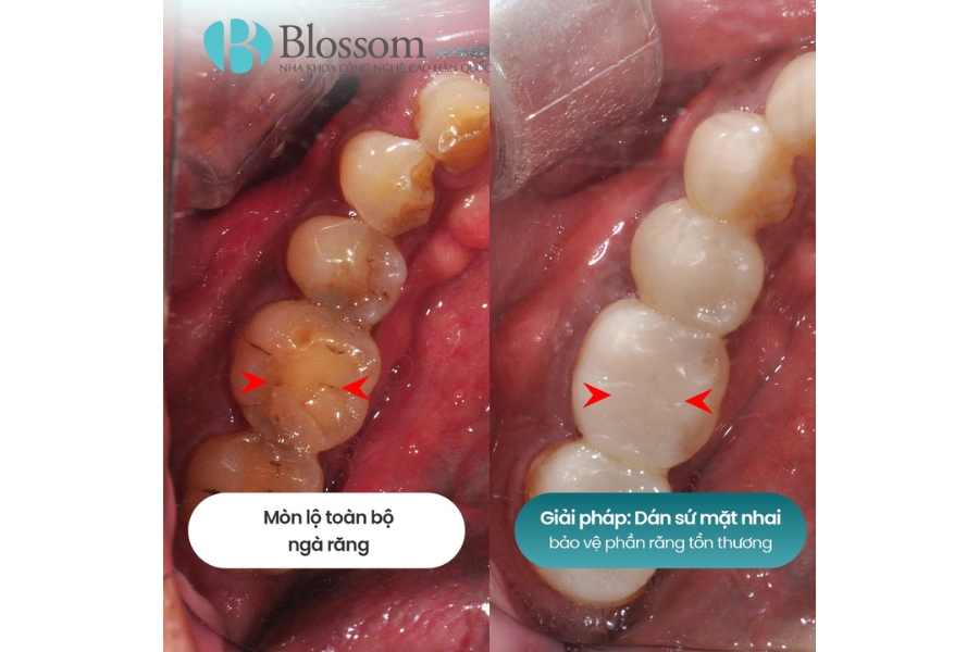 Mòn răng trầm trọng: Nguyên nhân, hậu quả và giải pháp phục hồi hiệu quả với dán sứ Lamifilm 9 mon rang tram trong 9