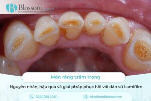 Răng bị mòn mặt nhai: Nguyên nhân, tác hại và giải pháp với dán sứ Lamifilm
