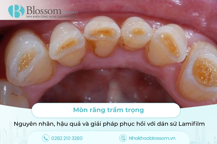 Răng bị mòn mặt nhai: Nguyên nhân, tác hại và giải pháp với dán sứ Lamifilm