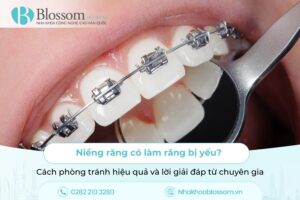 Niềng răng có làm răng bị yếu? Cách phòng tránh hiệu quả và lời giải đáp từ chuyên gia