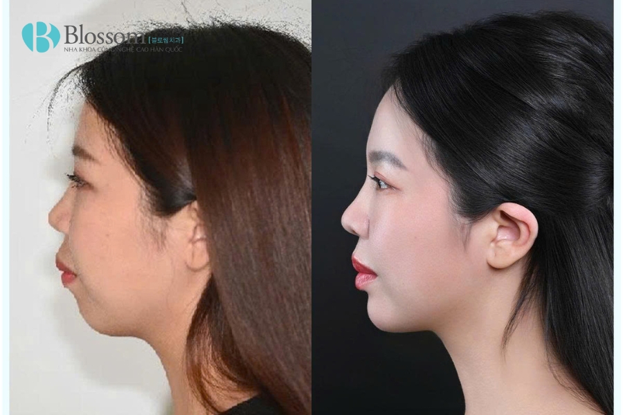 Niềng răng có làm thay đổi khuôn mặt không? Giải mã toàn diện từ A–Z 1 nieng rang co lam thay doi khuon mat 1