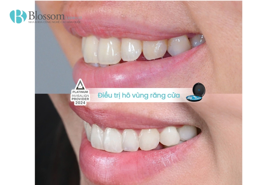Niềng răng có làm thay đổi khuôn mặt không? Giải mã toàn diện từ A–Z 2 nieng rang co lam thay doi khuon mat 2