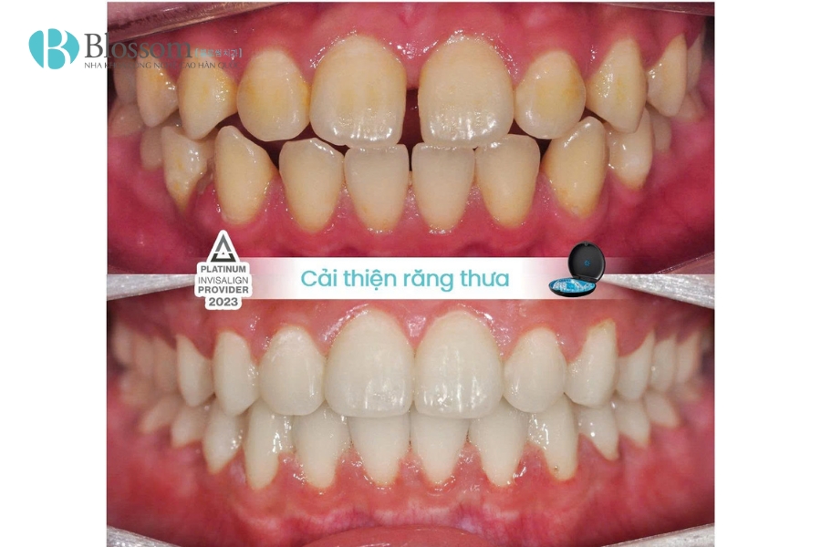 Niềng răng có làm thay đổi khuôn mặt không? Giải mã toàn diện từ A–Z 6 nieng rang co lam thay doi khuon mat 5
