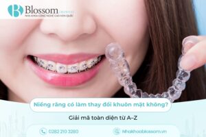 Niềng răng có làm thay đổi khuôn mặt không? Giải mã toàn diện từ A–Z