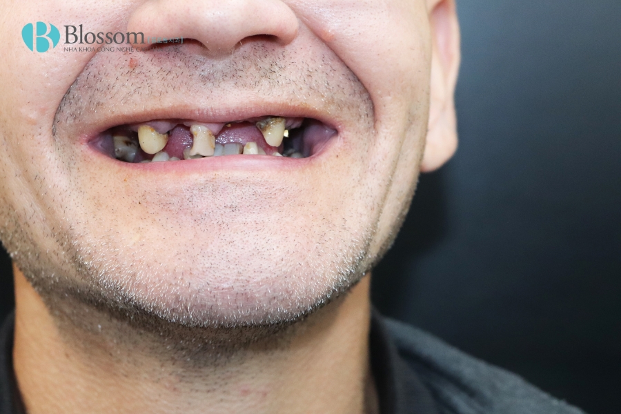 Các phương pháp trồng răng giả phổ biến hiện nay: Ưu – nhược điểm và chi phí trồng răng giả 2 phuong phap trong rang gia 2