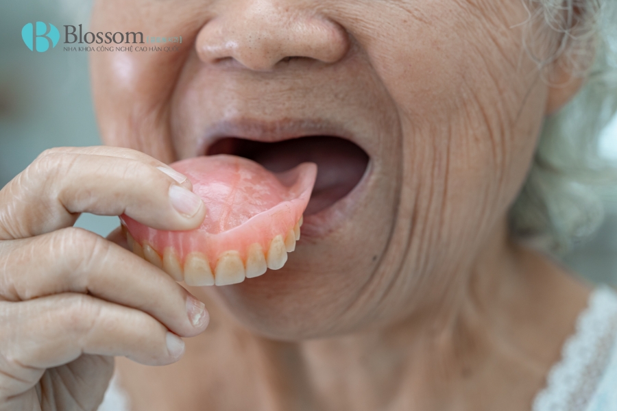 Các phương pháp trồng răng giả phổ biến hiện nay: Ưu – nhược điểm và chi phí trồng răng giả 3 phuong phap trong rang gia 3