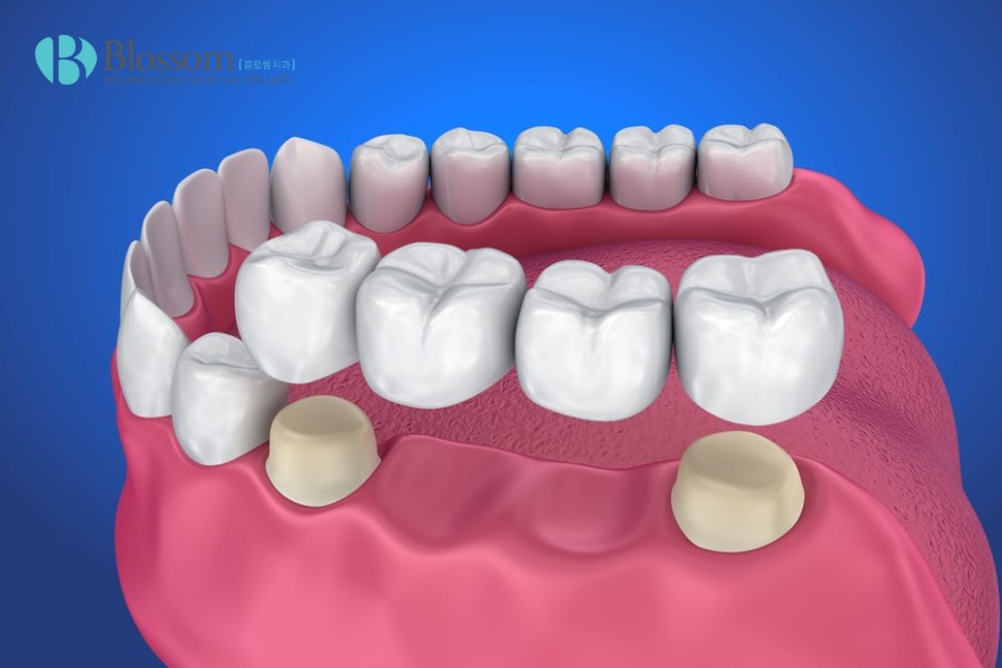 Các phương pháp trồng răng giả phổ biến hiện nay: Ưu – nhược điểm và chi phí trồng răng giả 4 phuong phap trong rang gia 4