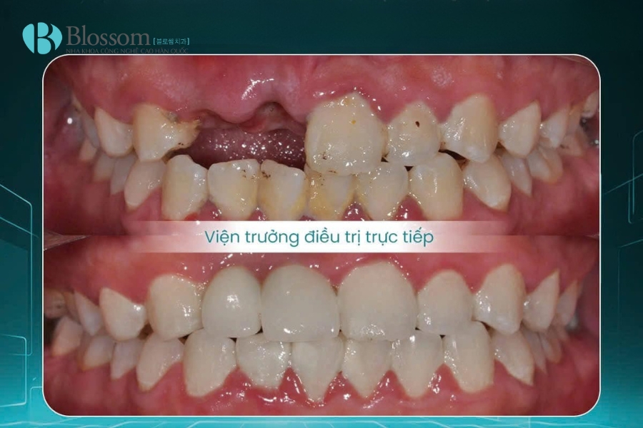 Các phương pháp trồng răng giả phổ biến hiện nay: Ưu – nhược điểm và chi phí trồng răng giả 5 phuong phap trong rang gia 5