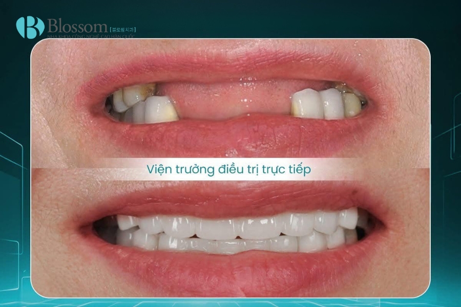 Các phương pháp trồng răng giả phổ biến hiện nay: Ưu – nhược điểm và chi phí trồng răng giả 6 phuong phap trong rang gia 6