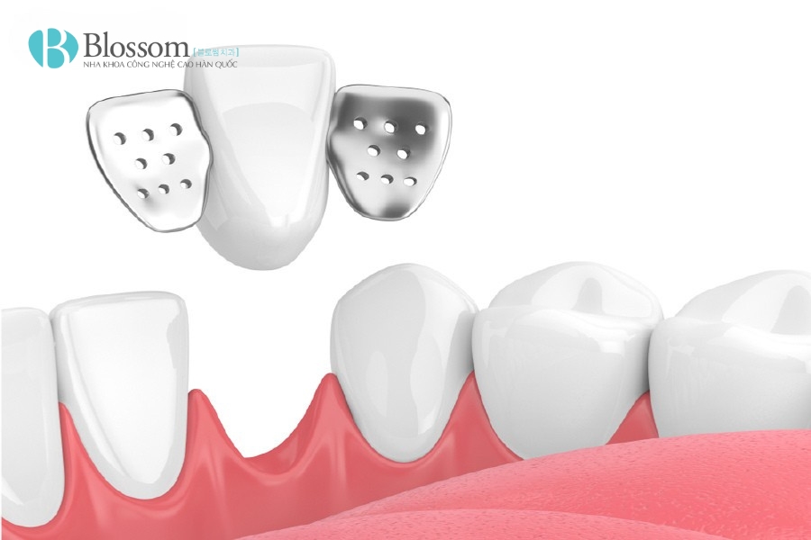 Các phương pháp trồng răng giả phổ biến hiện nay: Ưu – nhược điểm và chi phí trồng răng giả 7 phuong phap trong rang gia 7