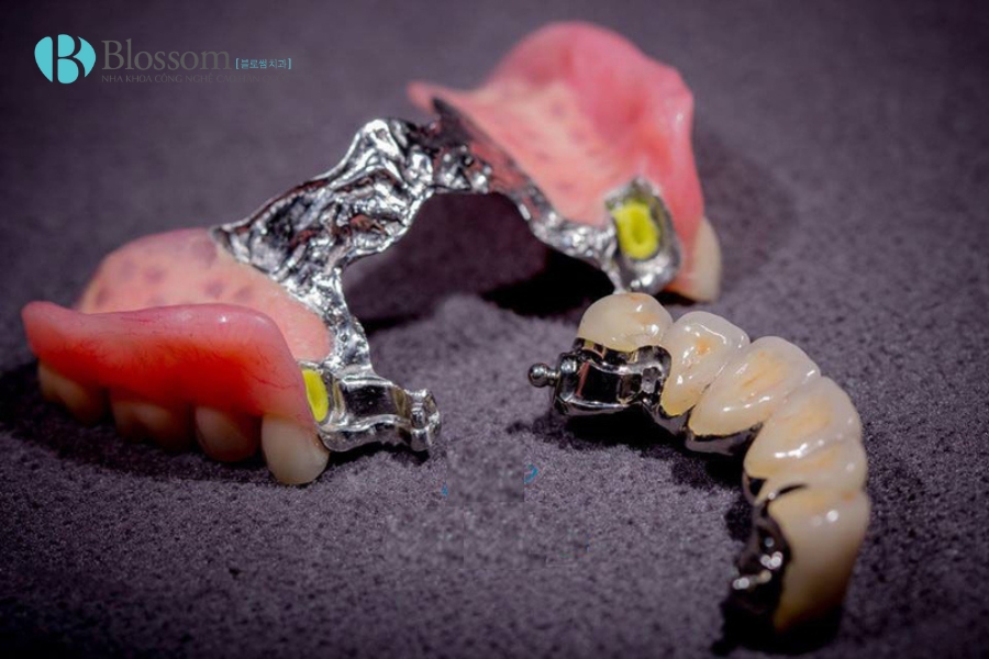 Các phương pháp trồng răng giả phổ biến hiện nay: Ưu – nhược điểm và chi phí trồng răng giả 8 phuong phap trong rang gia 8