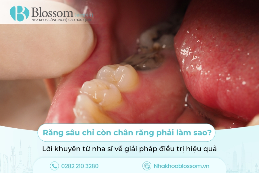 Răng sâu chỉ còn chân răng phải làm sao? Lời khuyên từ nha sĩ về giải pháp điều trị hiệu quả