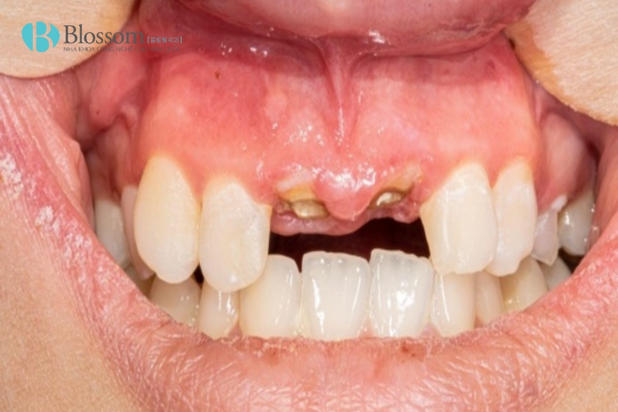 Răng sâu chỉ còn chân răng phải làm sao? Lời khuyên từ nha sĩ về giải pháp điều trị hiệu quả 2 sau chi con chan rang 2
