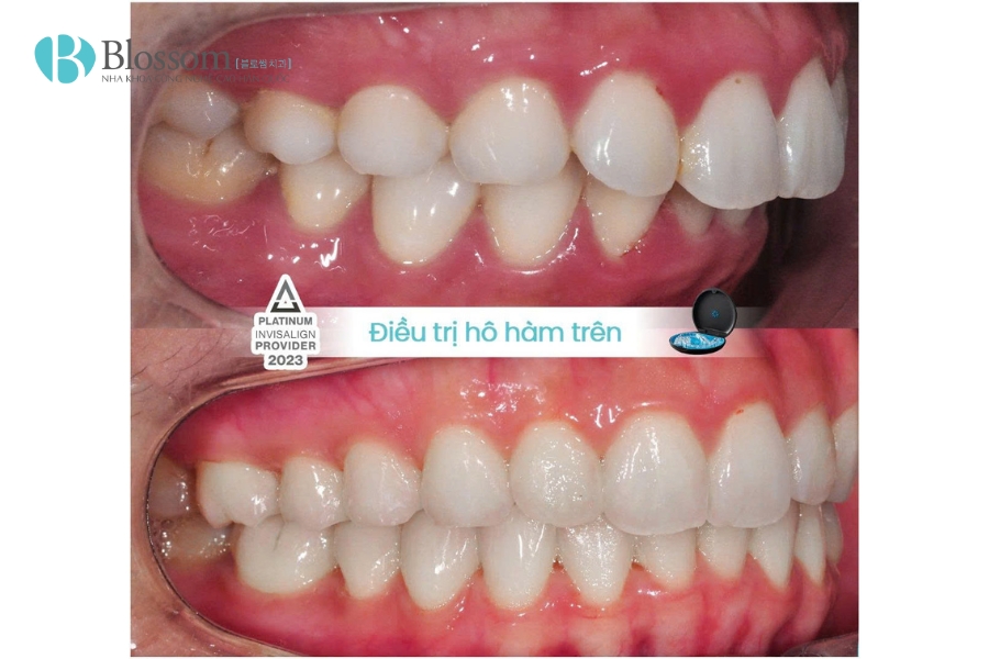 Tác hại của niềng răng: Đừng bỏ qua 10 điều này nếu bạn đang có ý định chỉnh nha 1 tac hai cua nieng rang 1