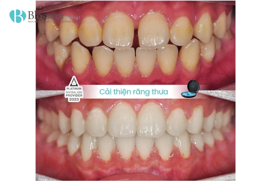 Tác hại của niềng răng: Đừng bỏ qua 10 điều này nếu bạn đang có ý định chỉnh nha 13 tac hai cua nieng rang 13
