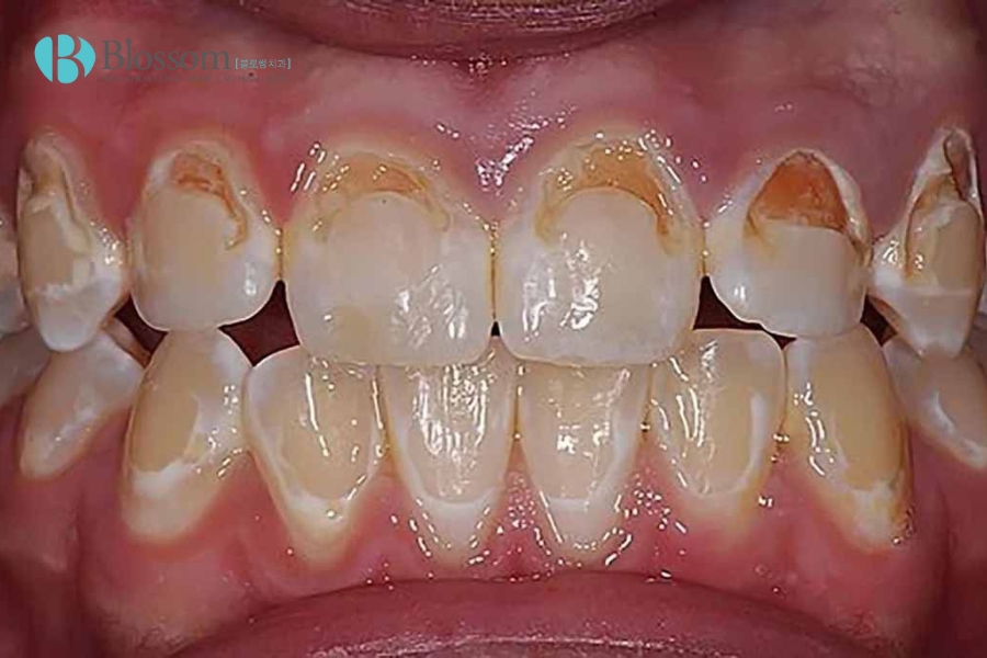 Tác hại của niềng răng: Đừng bỏ qua 10 điều này nếu bạn đang có ý định chỉnh nha 3 tac hai cua nieng rang 3