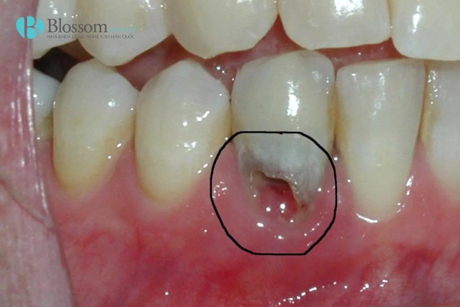 Tác hại của niềng răng: Đừng bỏ qua 10 điều này nếu bạn đang có ý định chỉnh nha 5 tac hai cua nieng rang 5