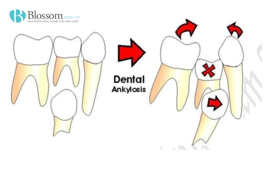 Tác hại của niềng răng: Đừng bỏ qua 10 điều này nếu bạn đang có ý định chỉnh nha 6 tac hai cua nieng rang 6