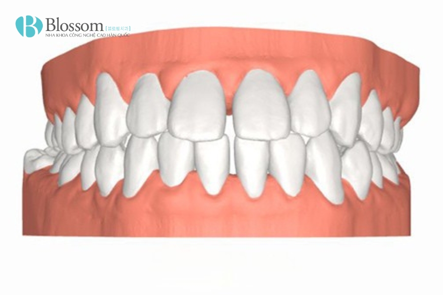 Tác hại của niềng răng: Đừng bỏ qua 10 điều này nếu bạn đang có ý định chỉnh nha 7 tac hai cua nieng rang 7