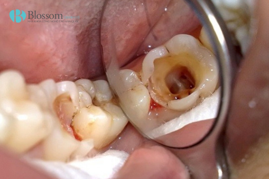 Khi nào cần trồng răng hàm bị sâu? Phương pháp nào tốt, giá bao nhiêu? 1 trong rang ham bi sau 1