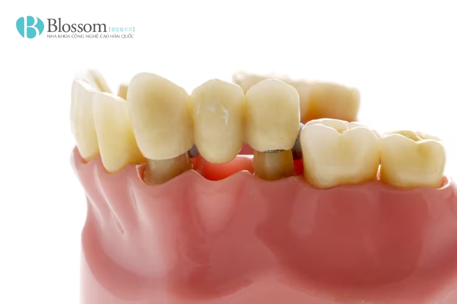 Khi nào cần trồng răng hàm bị sâu? Phương pháp nào tốt, giá bao nhiêu? 3 trong rang ham bi sau 3